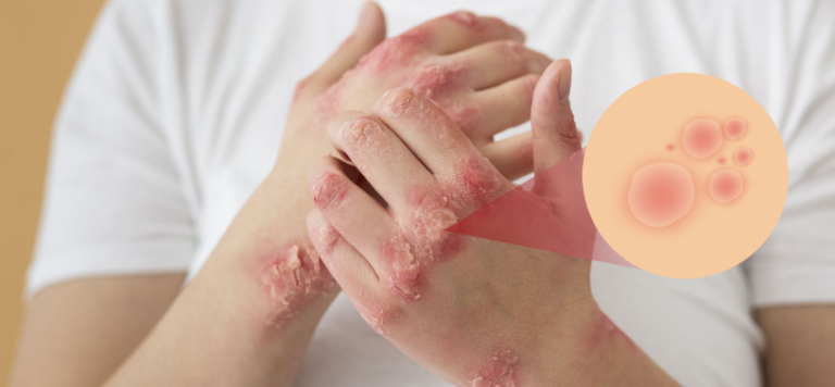 Psoriasis